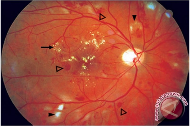 Penderita Diabetes Mellitus Berisiko Terkena Retinopati Diabetik ...