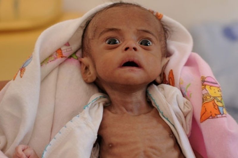 Ratusan Balita Menderita Kurang Gizi Antara News Kalteng