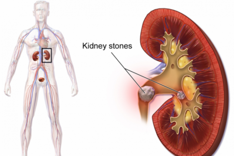 Ketahui apa itu batu ginjal dan teknik pengobatannya