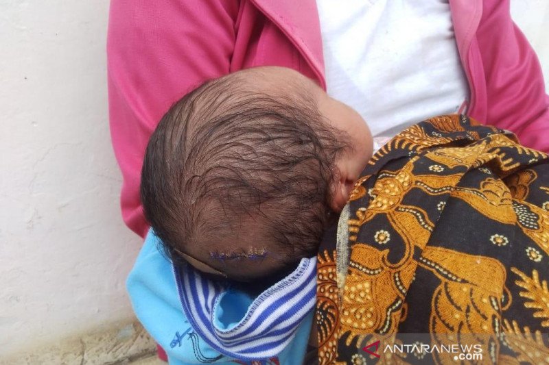 RSUD : Jahitan Pada Kepala Bayi Karena Luka Terkena Alat Medis
