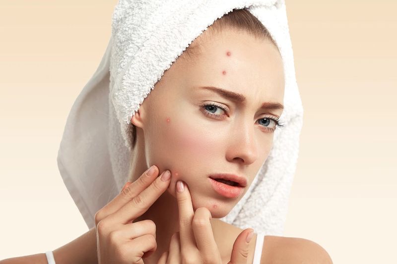 Dokter: Penggunaan acne patch tak terlalu efektif untuk jerawat