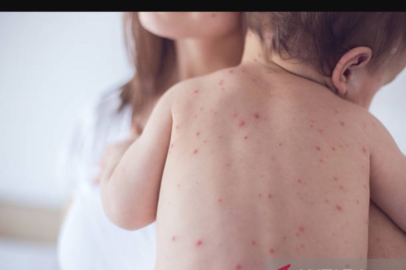 Border factors and minimal immunization trigger measles transmission – ANTARA News Mataram