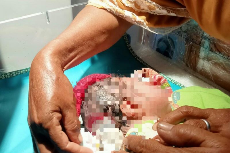 Seorang bayi di Lombok Tengah lahir dengan kondisi kepala bolong