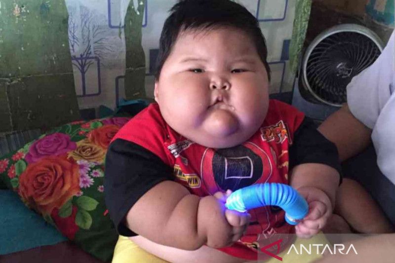 Balita idap obesitas di Bekasi jalani rawat jalan intensif