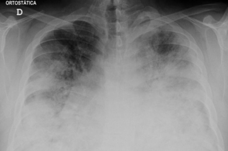 Satu orang meninggal, 26 terinfeksi Legionnaires di Swiss