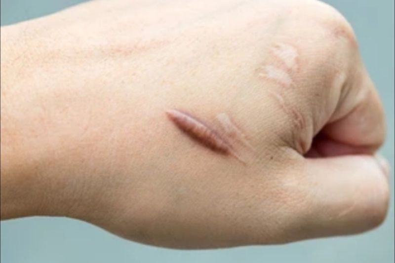 Tips menghilangkan bekas luka membandel
