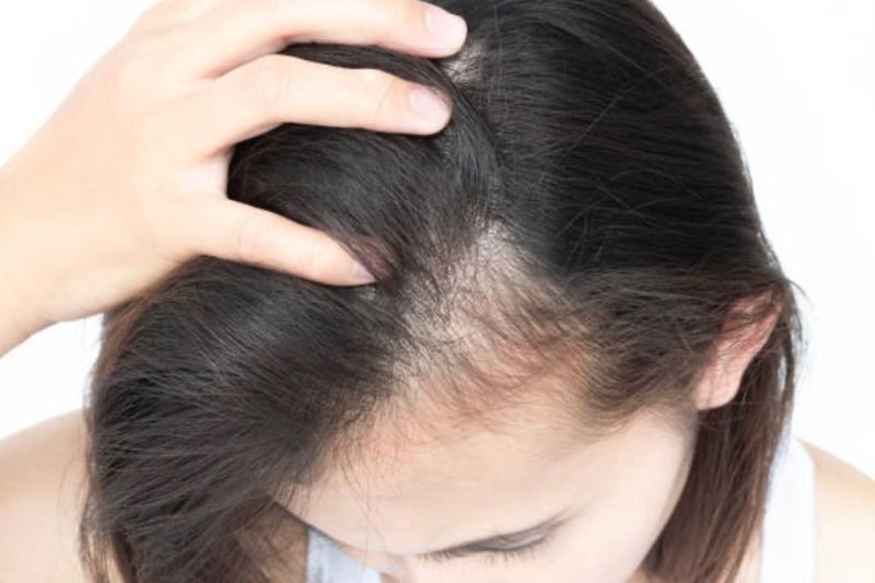 5 penyebab rambut menipis hingga berujung kebotakan