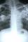 Penderita TB di Indonesia Peringkat Ketiga Dunia